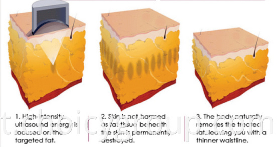 Liposunic Working theory